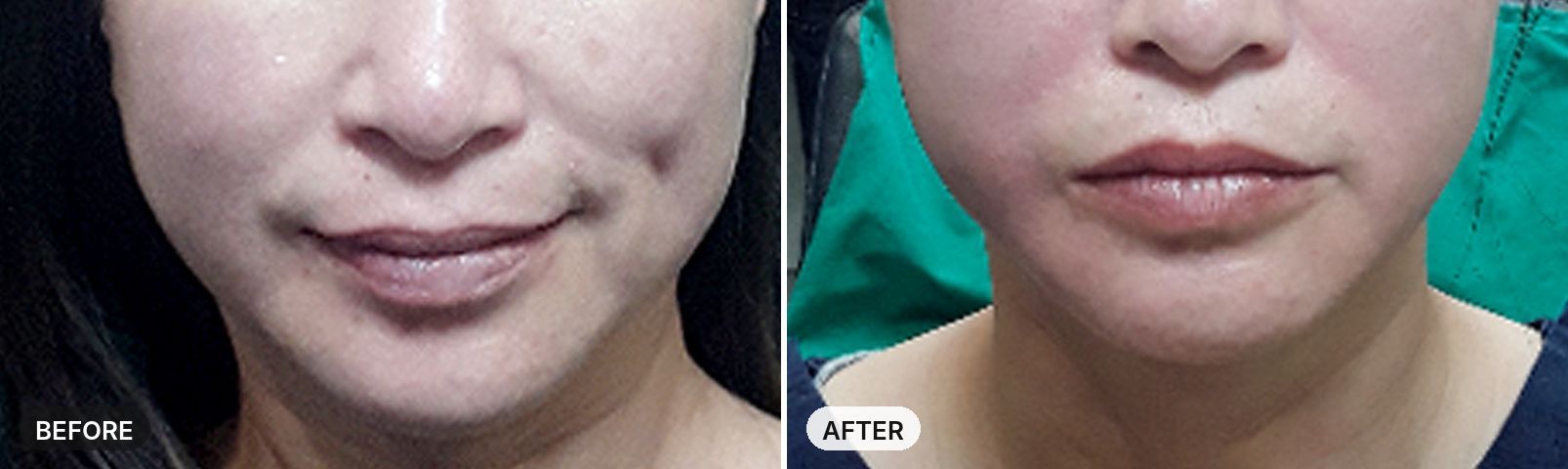 Aptos Thread Lift before and after, case 1, JRYN Seomyeon Busan