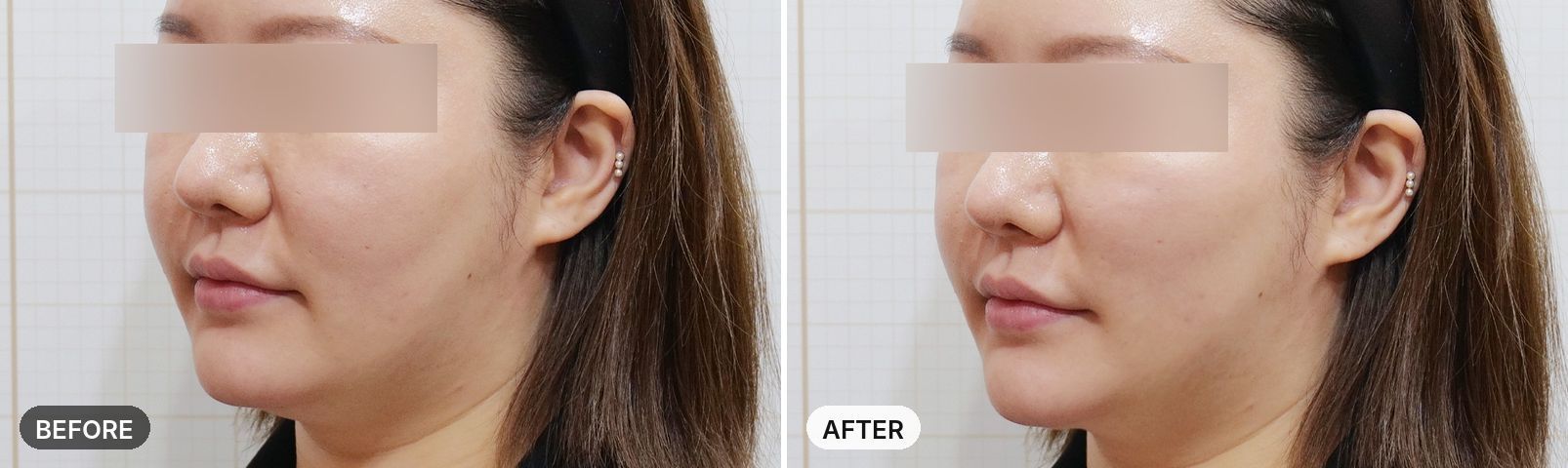 Sofwave before and after