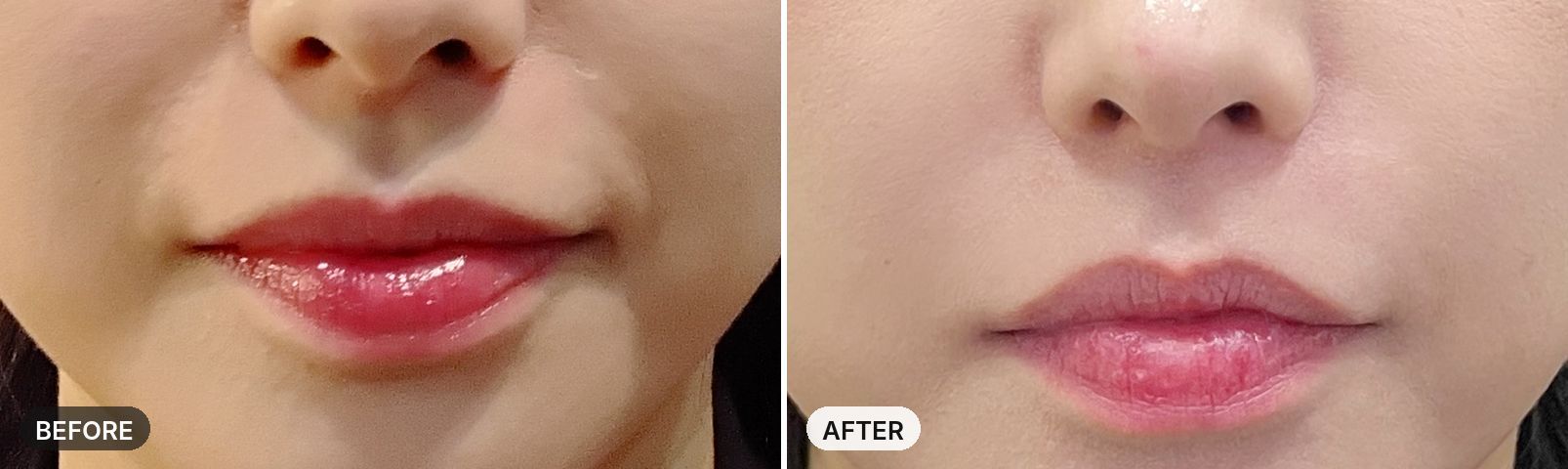 Nasolabial Fold Filler before and after