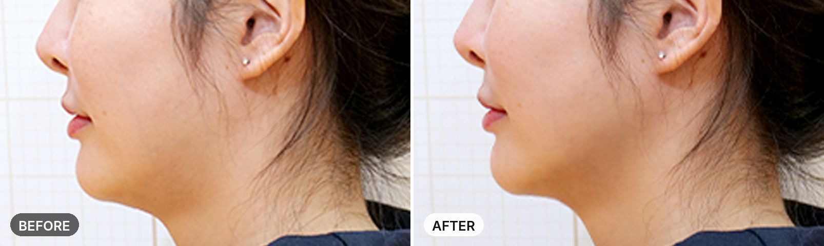 Titanium Lifting before and after, case 5, JRYN Seomyeon Busan