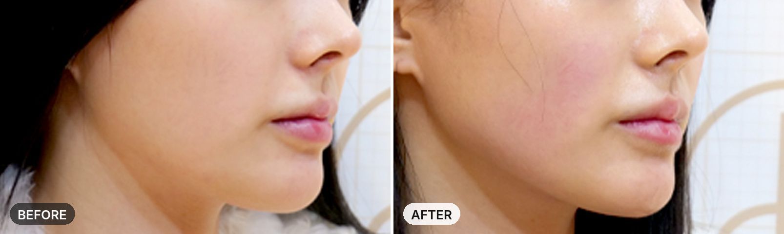 Titanium Lifting before and after, case 4, JRYN Seomyeon Busan