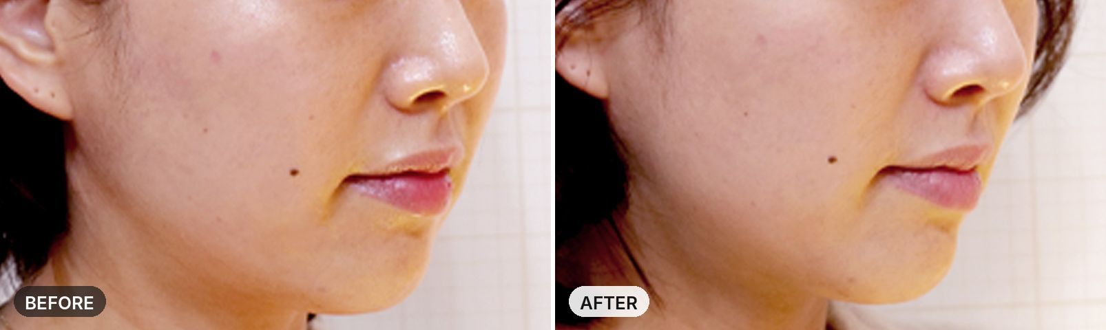 Titanium Lifting before and after, case 3, JRYN Seomyeon Busan