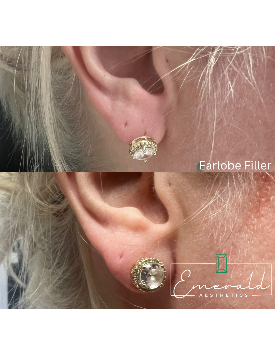 Close-up of an ear with a small gold ear lobe filler stud and a larger gold earring beneath it.