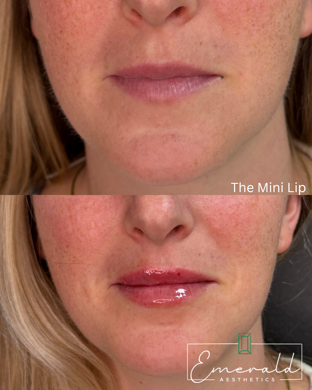 Before-and-after close-up of lips: natural lips above, glossy enhanced lips below.