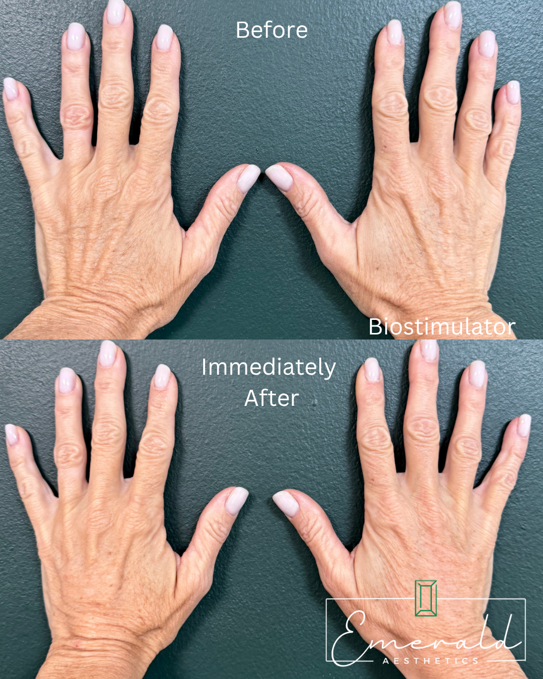 Hands before and immediately after treatment, showing reduced age spots and smoother skin.