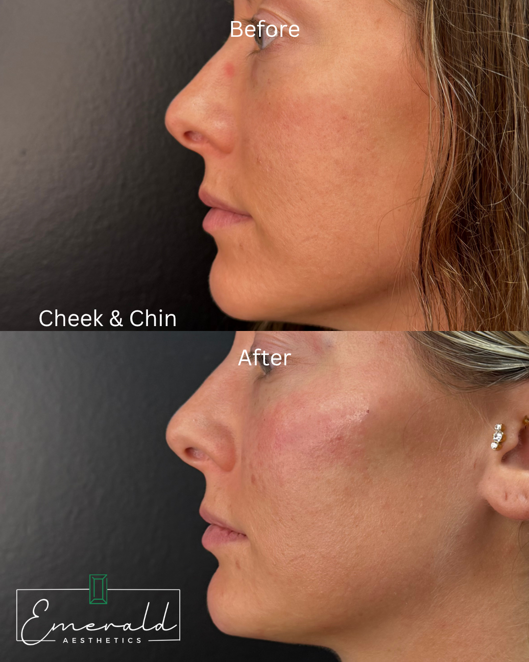 Side-by-side profile comparison labeled Before and After of cheek and chin contour on a woman’s face.