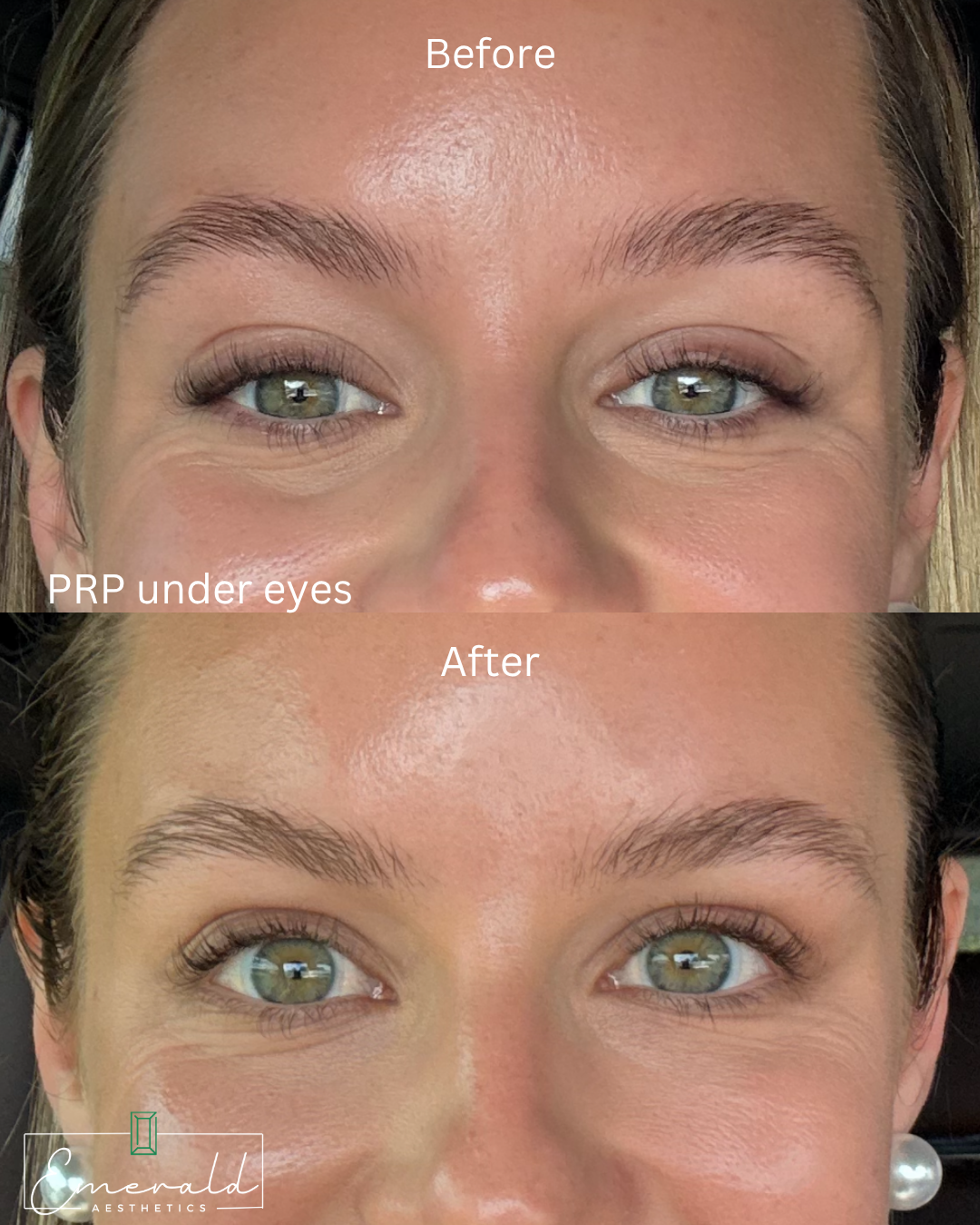 Before-and-after close-up of under-eye PRP treatment results on a woman’s face.