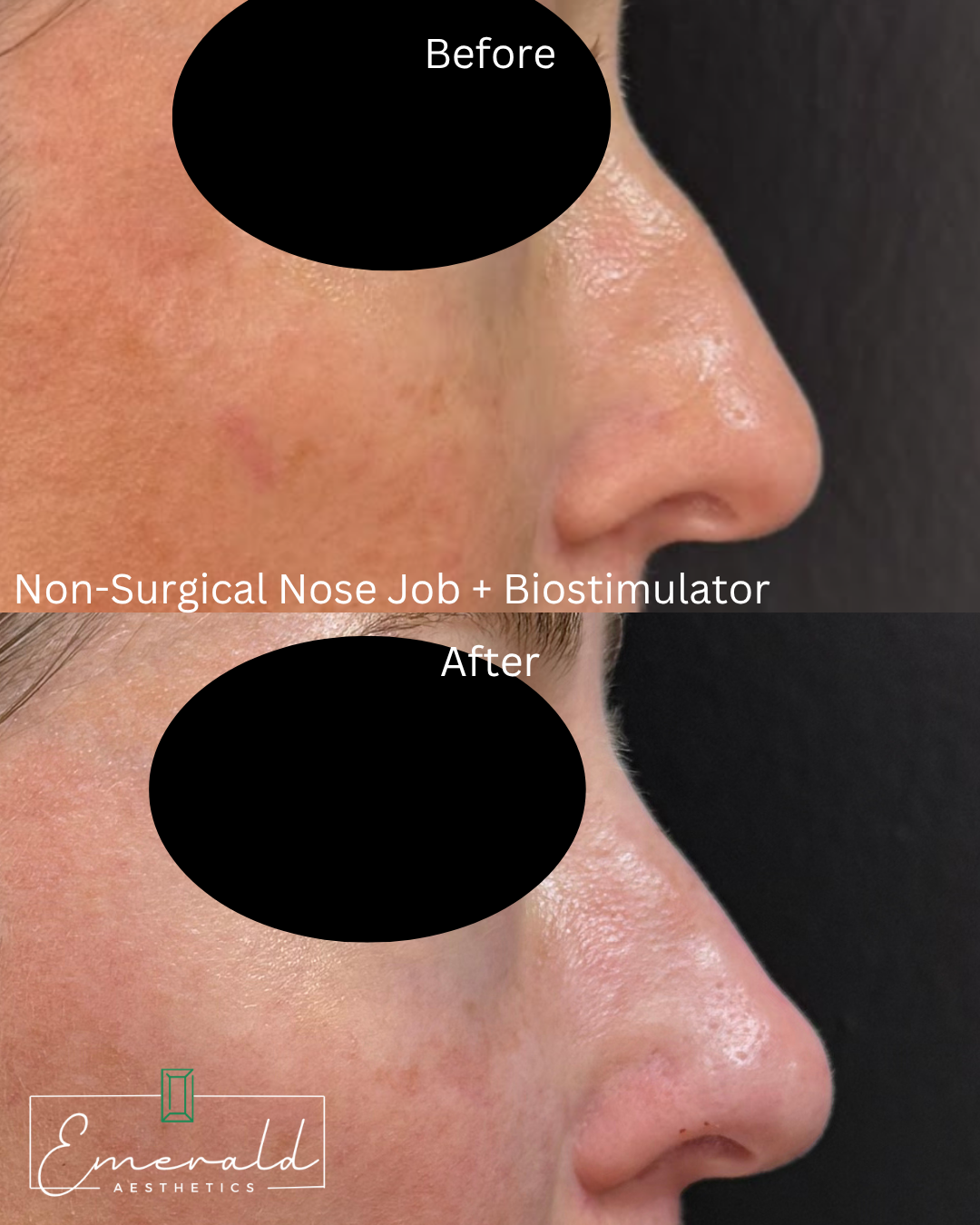 Before-and-after side profile of a nose, showing a non-surgical nose job with biostimulator.