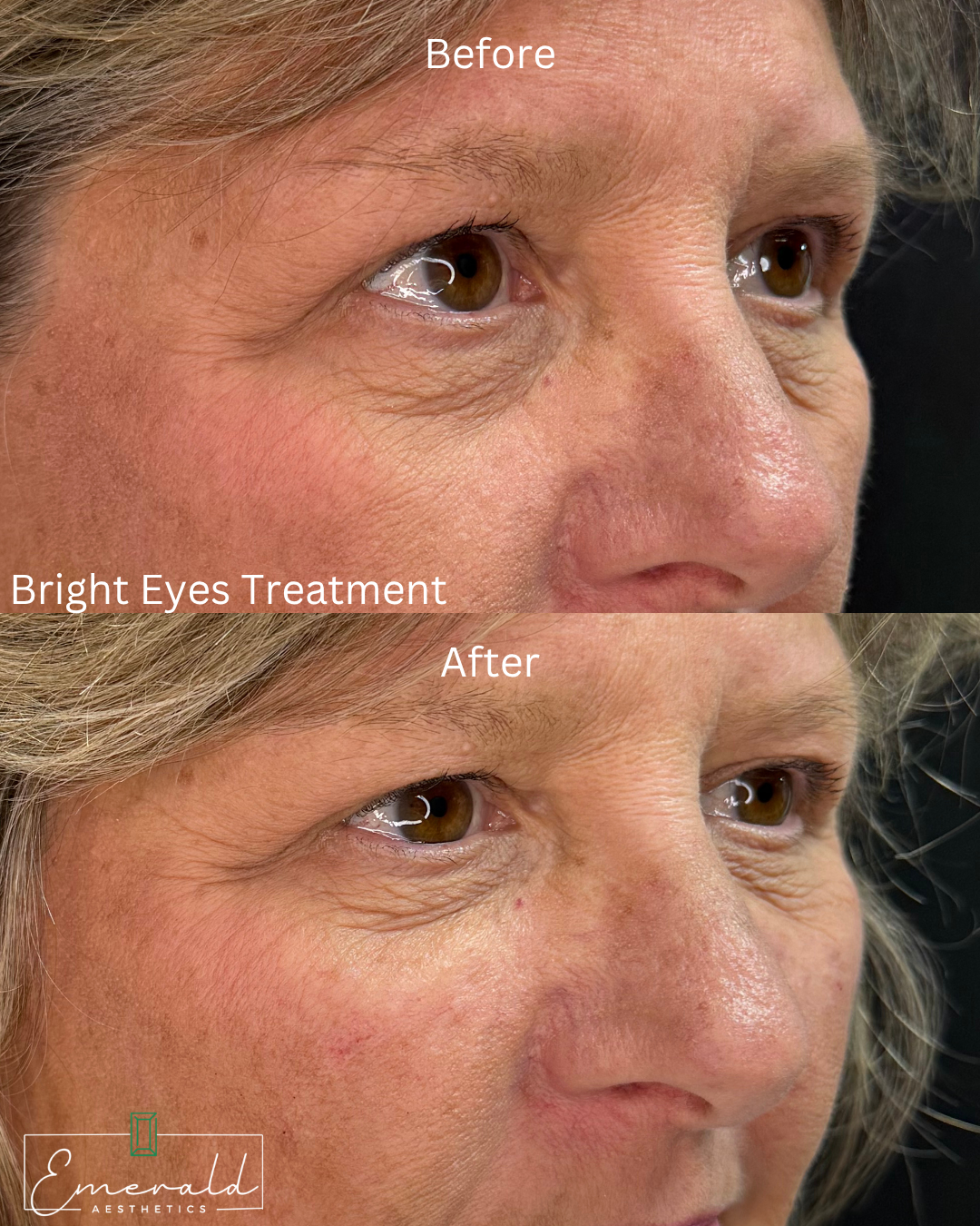 Before-and-after close-up of eyes, showing brighter-looking eyes after treatment.