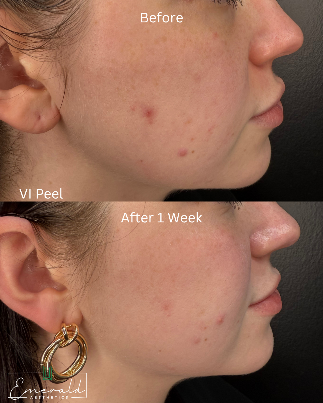 Before-and-after side profile of a cheek with acne marks, labeled 