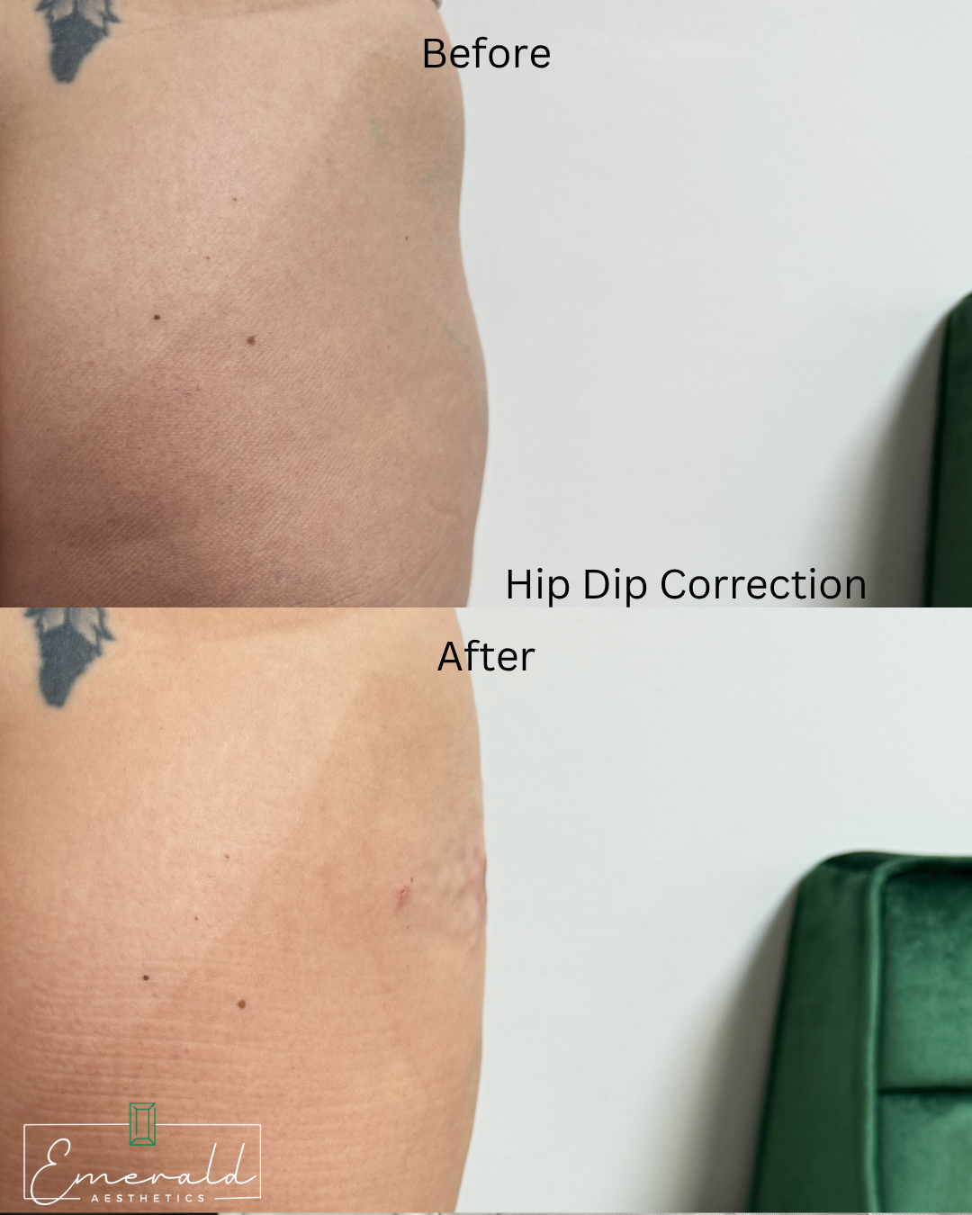 Side-view torso comparison labeled “Before” and “After,” showing hip dip correction.