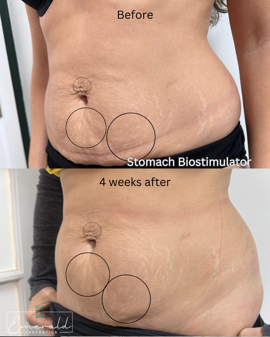 Before and after torso photo labeled “Stomach Biostimulator,” showing abdominal skin changes after 4 weeks.