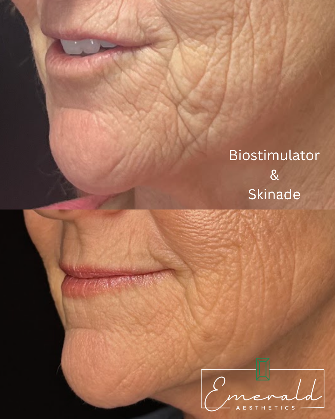 Side-by-side close-up of lower face and neck with wrinkle reduction; text reads “Biostimulator & Skincare”.