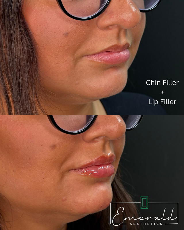 Before-and-after side profile showing chin and lip filler results on a woman with glasses.