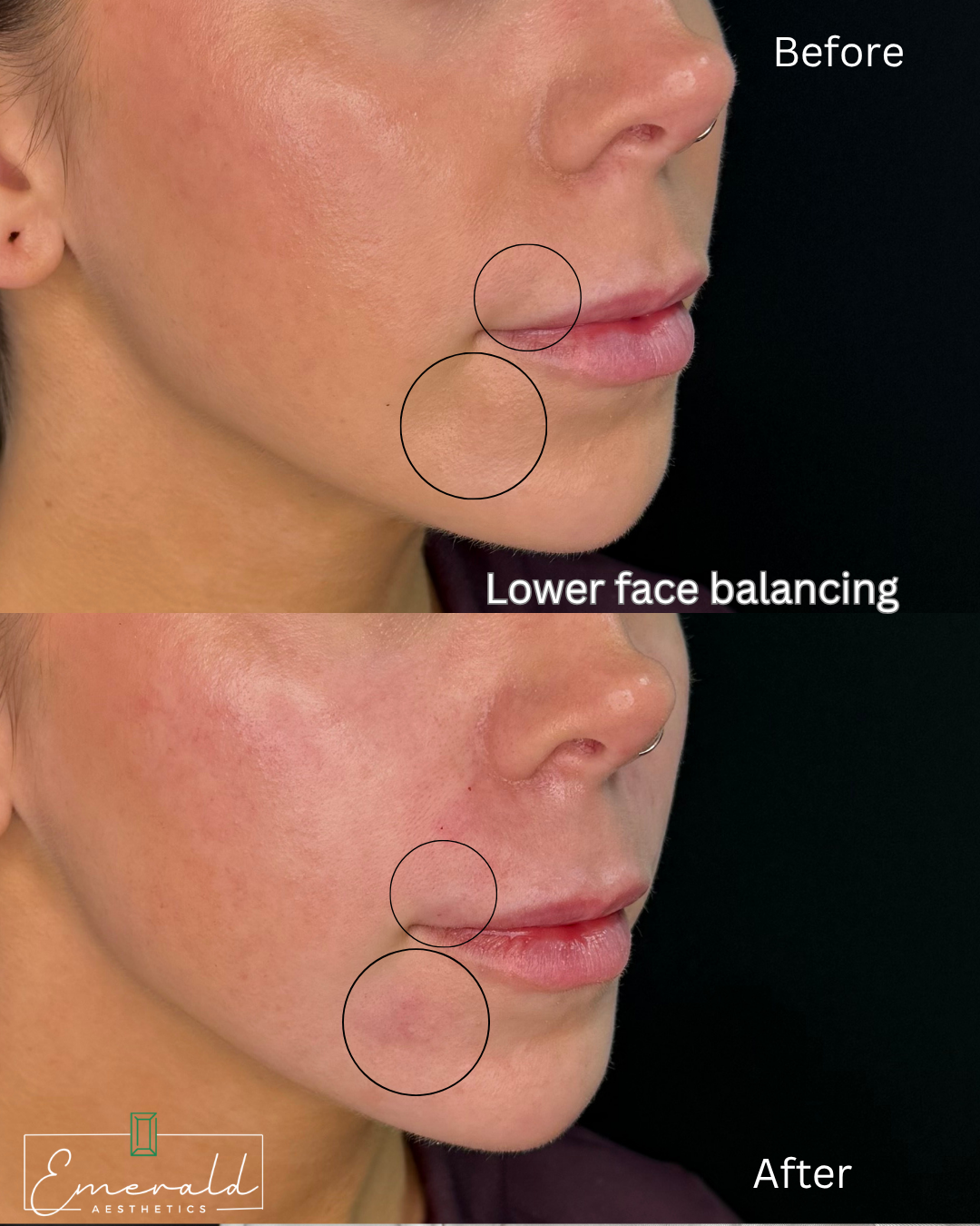 Before-and-after profile photos showing lower-face balancing with marked cheek and jaw areas.