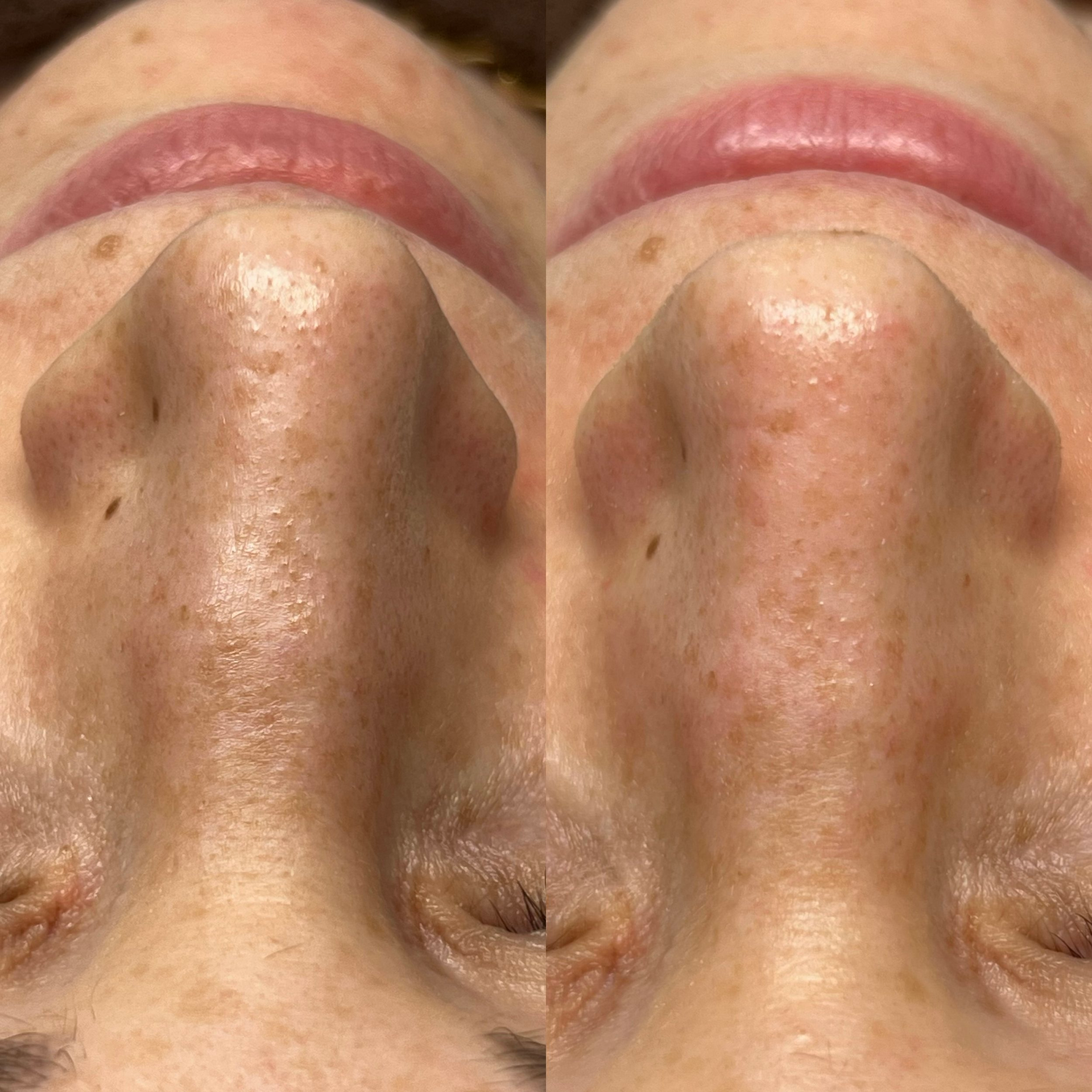 A before and after photo of a woman 's nose.