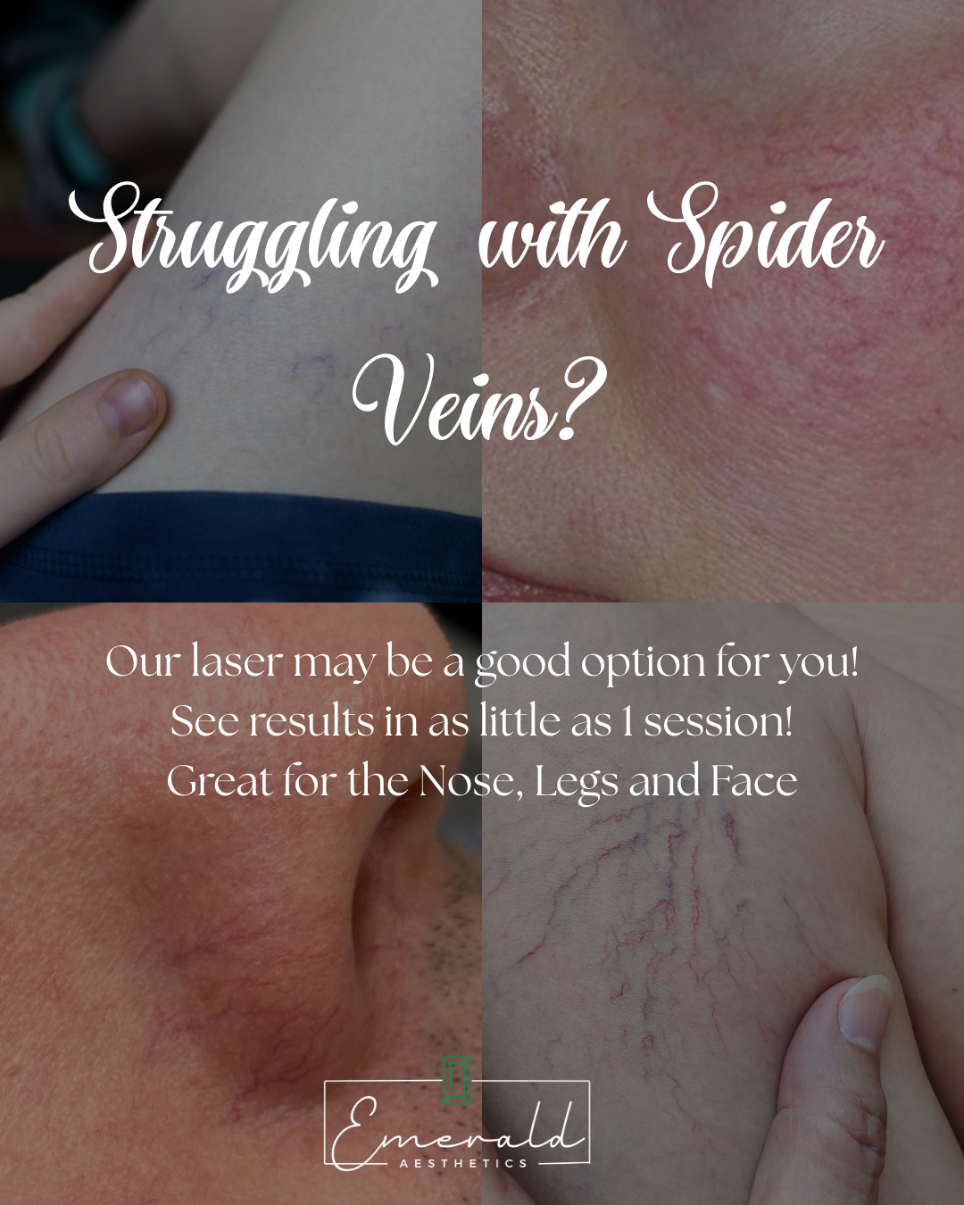 Laser treatment ad for spider veins on leg and face, with close-up skin photos and white text.