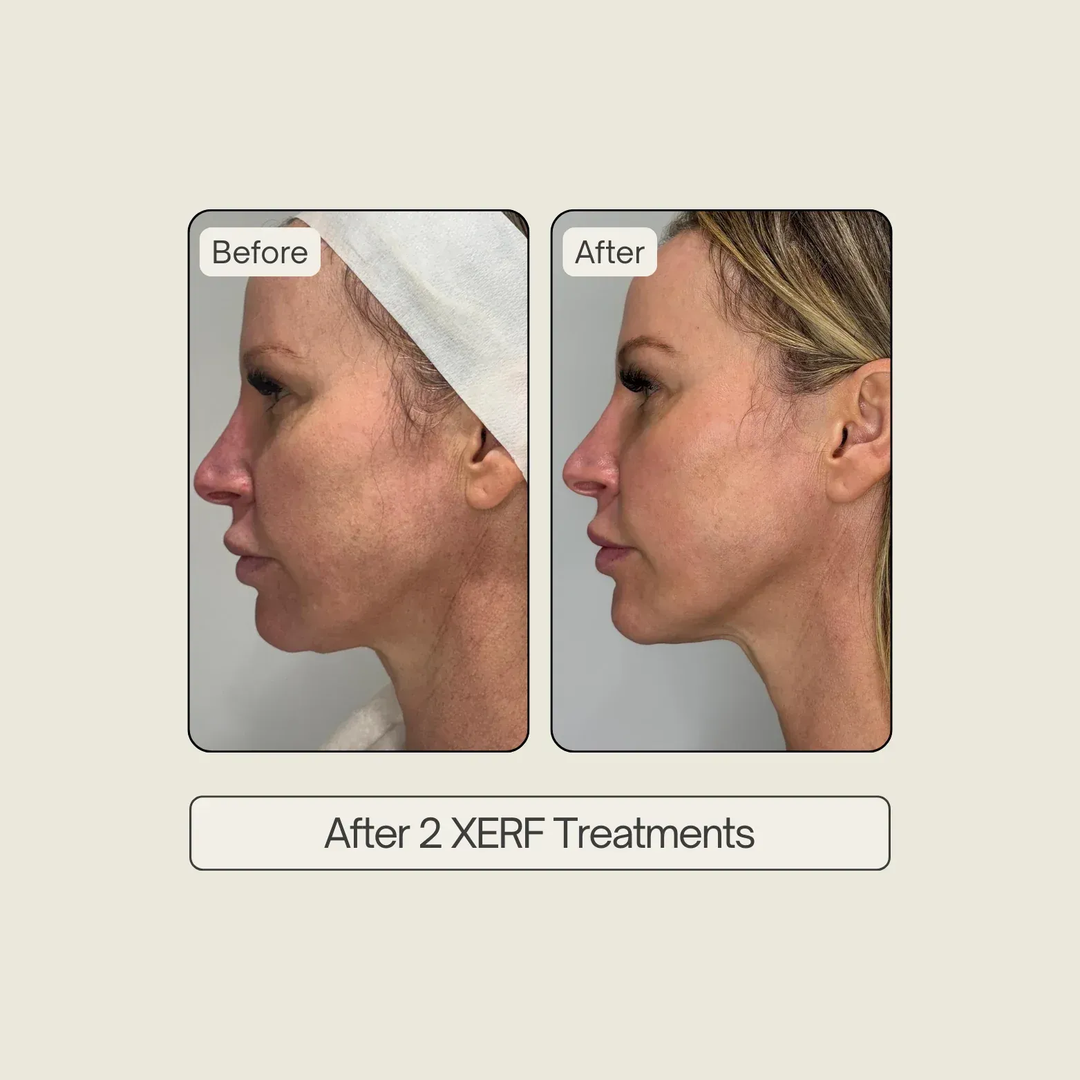 Aesthetic treatment in progress, woman lying on a spa bed while a technician uses a handheld device on her face.