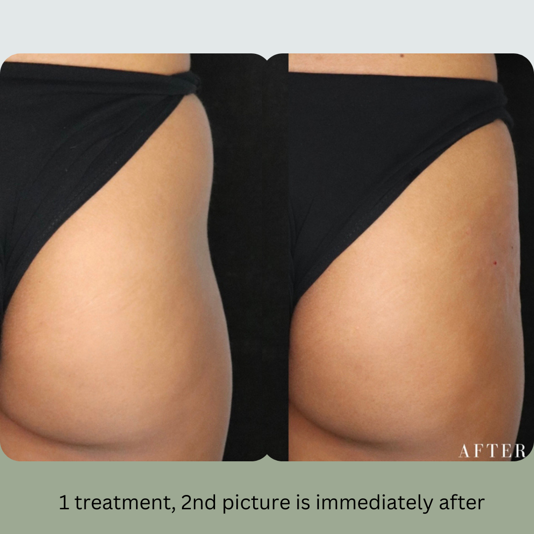 Side-by-side close-up of a person's lower back/hips in black underwear, showing before and after treatment.