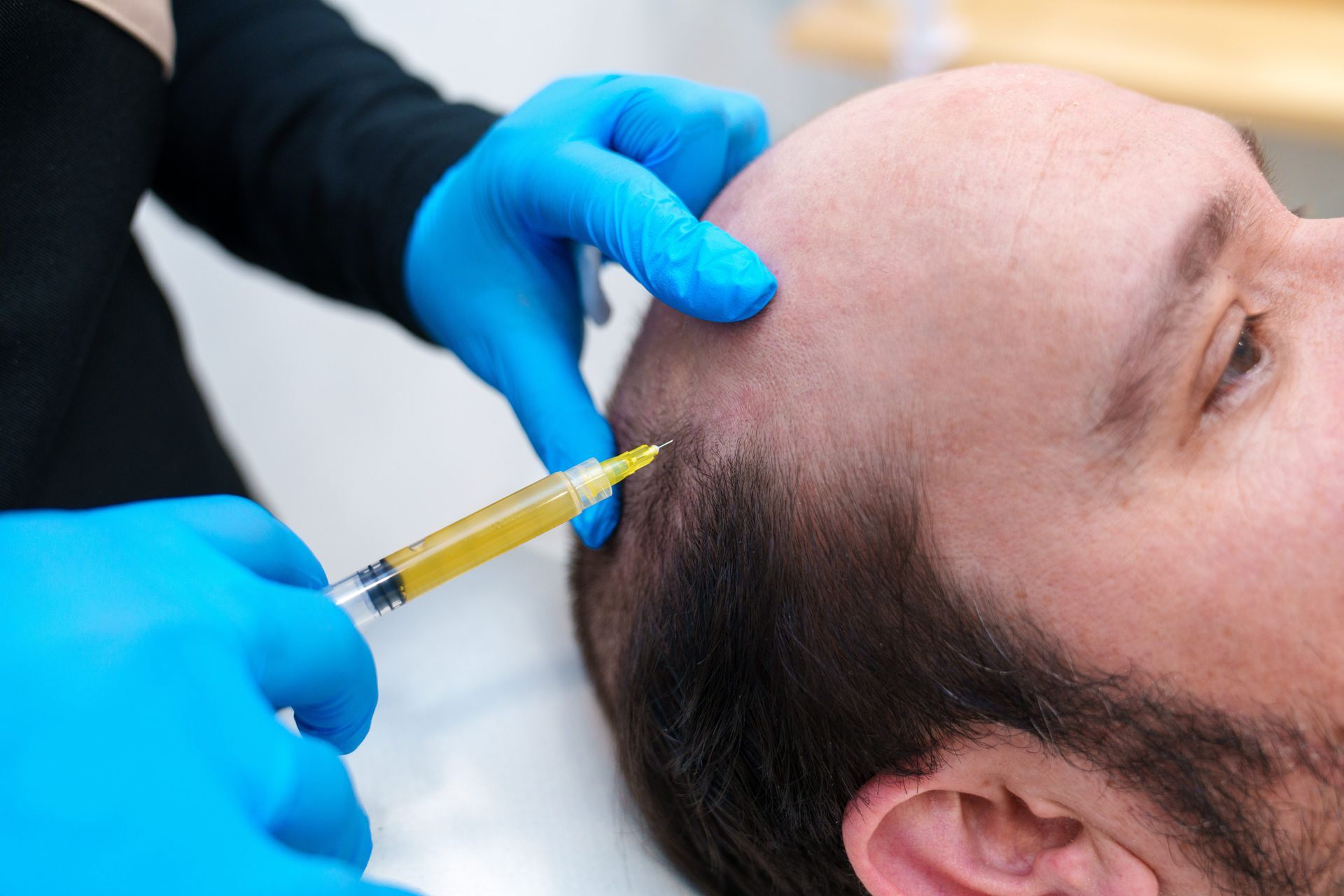 Gloved hands injecting a bald man’s scalp with a syringe for hair treatment