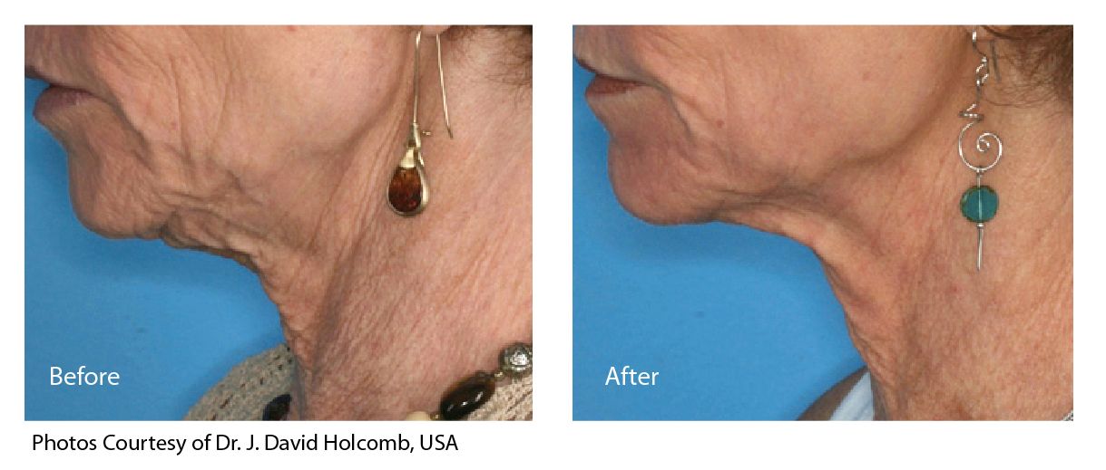 Side-by-side close-up of a lower face before and after skin treatment, showing smoother skin on the right