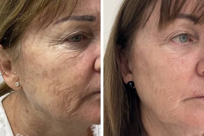 Side-by-side close-up profile photos of a woman’s face showing skin texture and wrinkles.