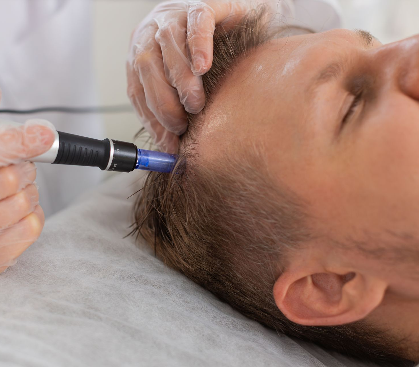 Scalp microneedling treatment: A gloved hand uses a device on a person's head, in a medical setting.