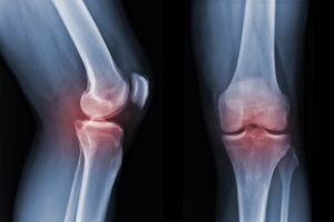 Orthopedic X-ray