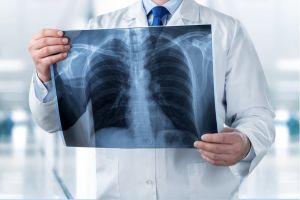 Mobile X-ray