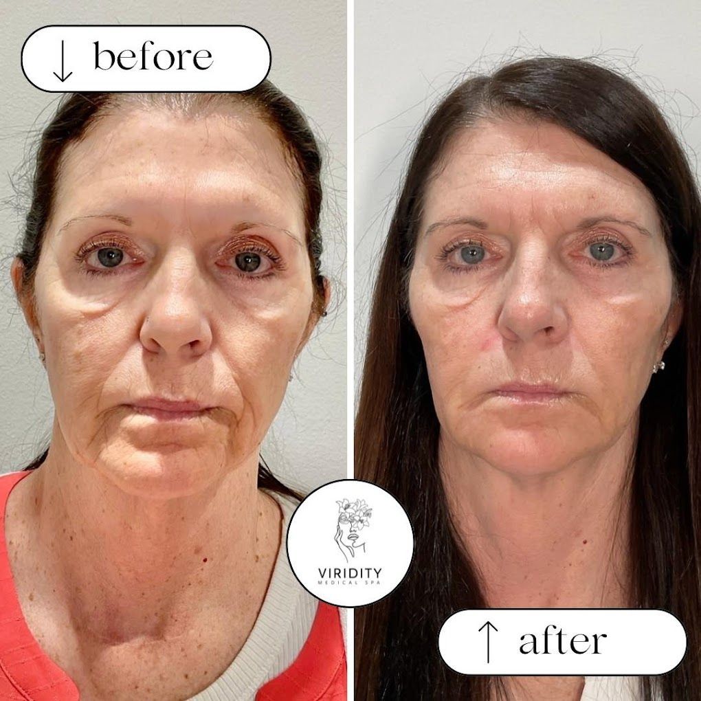 A before and after photo of a woman 's face.