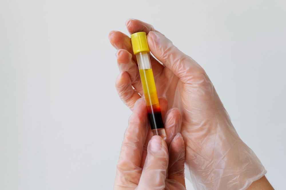 Hands holding a yellow-capped blood sample tube with a red liquid layer at the bottom