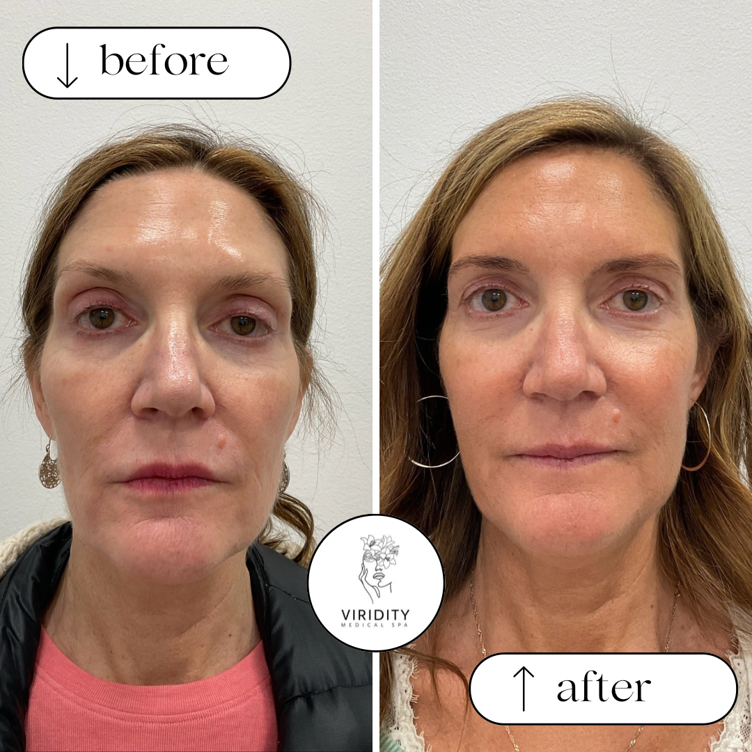 Before and after photos of a woman's face. "Before" shows some wrinkles, "after" shows a smoother appearance.