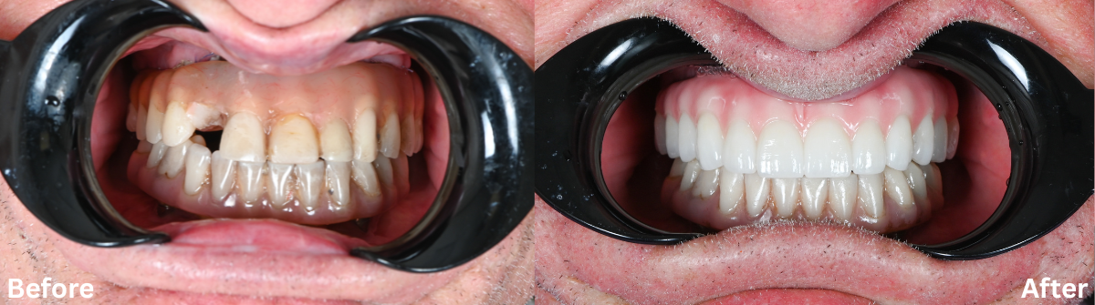 Side-by-side comparison of a patient's teeth 