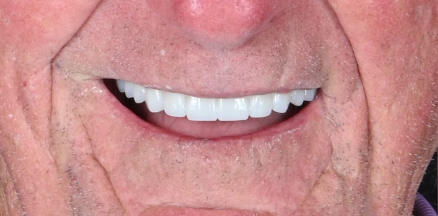 After of a man's smile with a missing tooth, and after dental work to replace it.