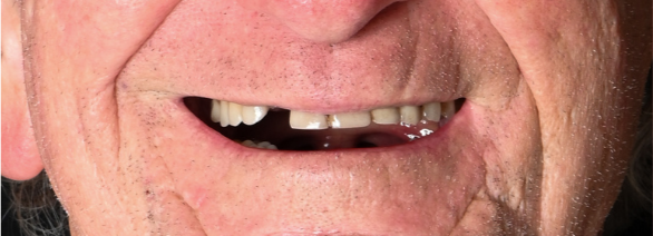 Before of a man's smile with a missing tooth, and after dental work to replace it.