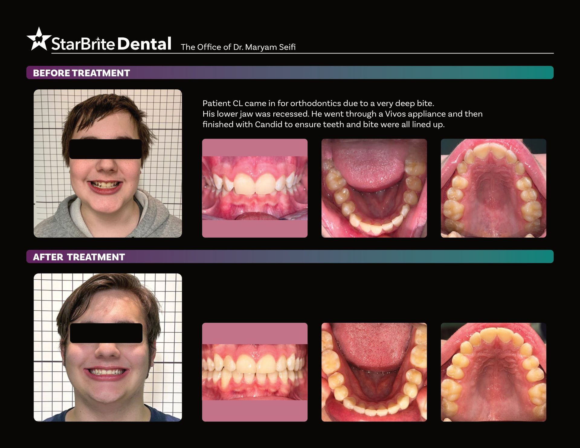 A before and after photo of a young man 's teeth