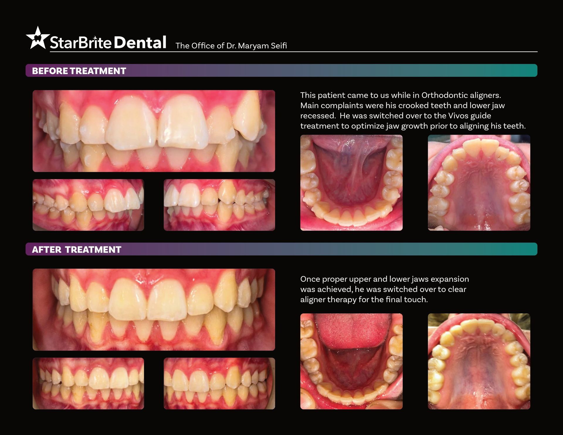 A poster showing a person 's teeth before and after treatment