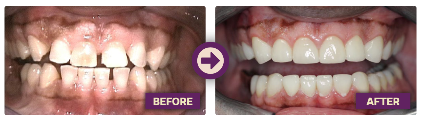 A before and after picture of a person 's teeth.