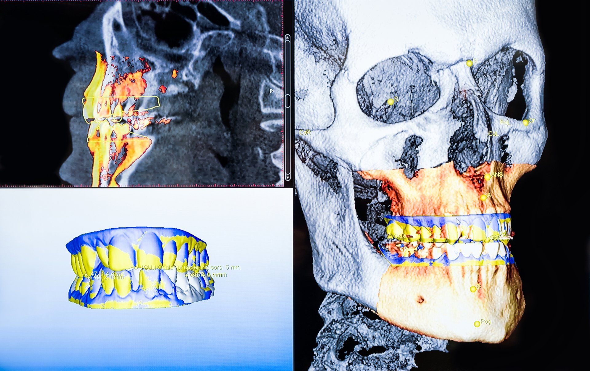 CBCT X-Ray Scanner Image 3D Dental X-Ray Imaging
