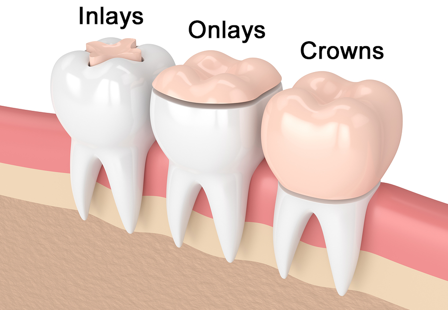 Gingivectomy