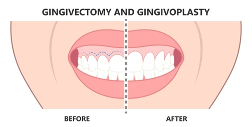 A before and after picture of a person 's teeth.