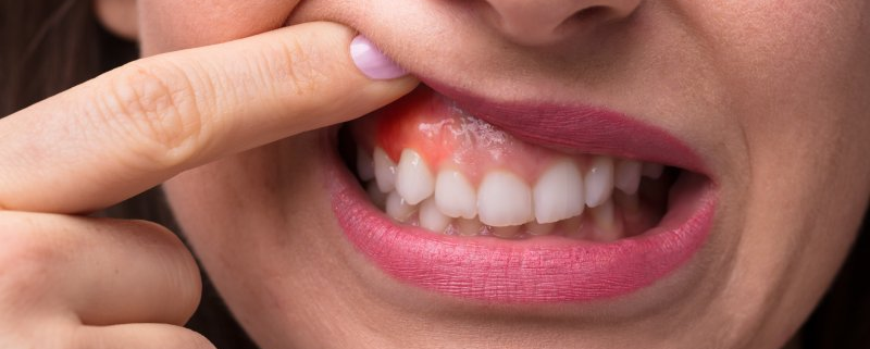 A close up of a woman 's mouth with a toothache.