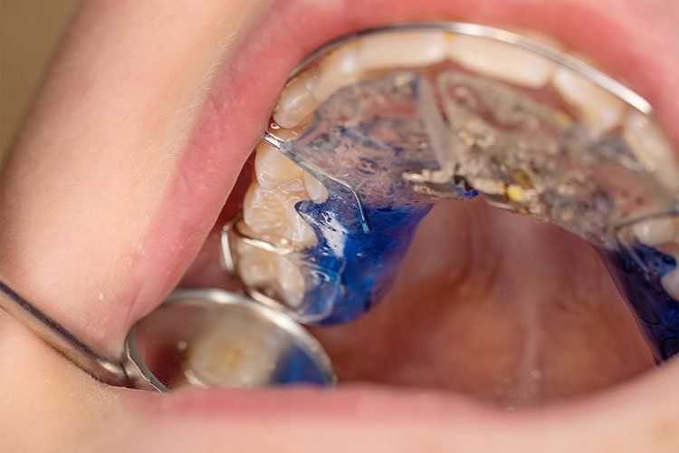 A close up of a person 's mouth with braces and a dental mirror.