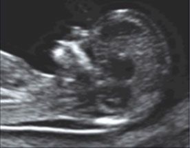 translucenza normale