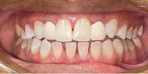 Close-up of a mouth showing teeth with braces during a smile
