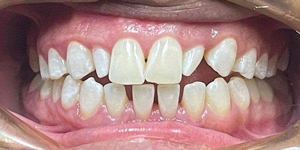 Close-up of a mouth showing teeth with gaps and crowding, gums visible