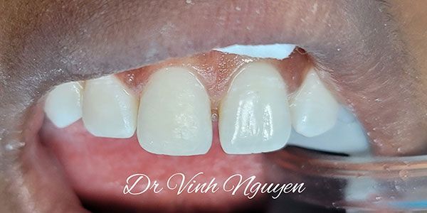 Close-up of upper front teeth with a gap and tooth whitening shade guide overlay