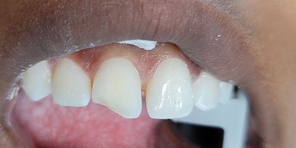 Close-up of a child’s mouth with a missing front tooth and visible teeth