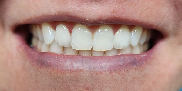 Close-up of a smiling mouth showing white teeth and pink lips