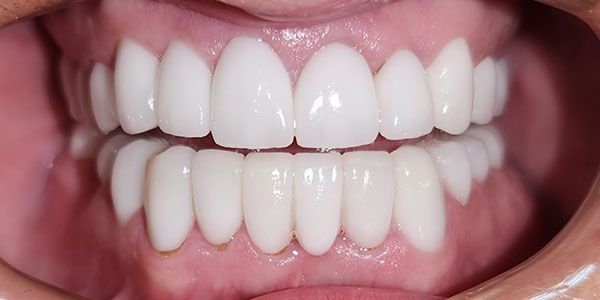 Close-up of a smiling mouth with straight white teeth and pink lips